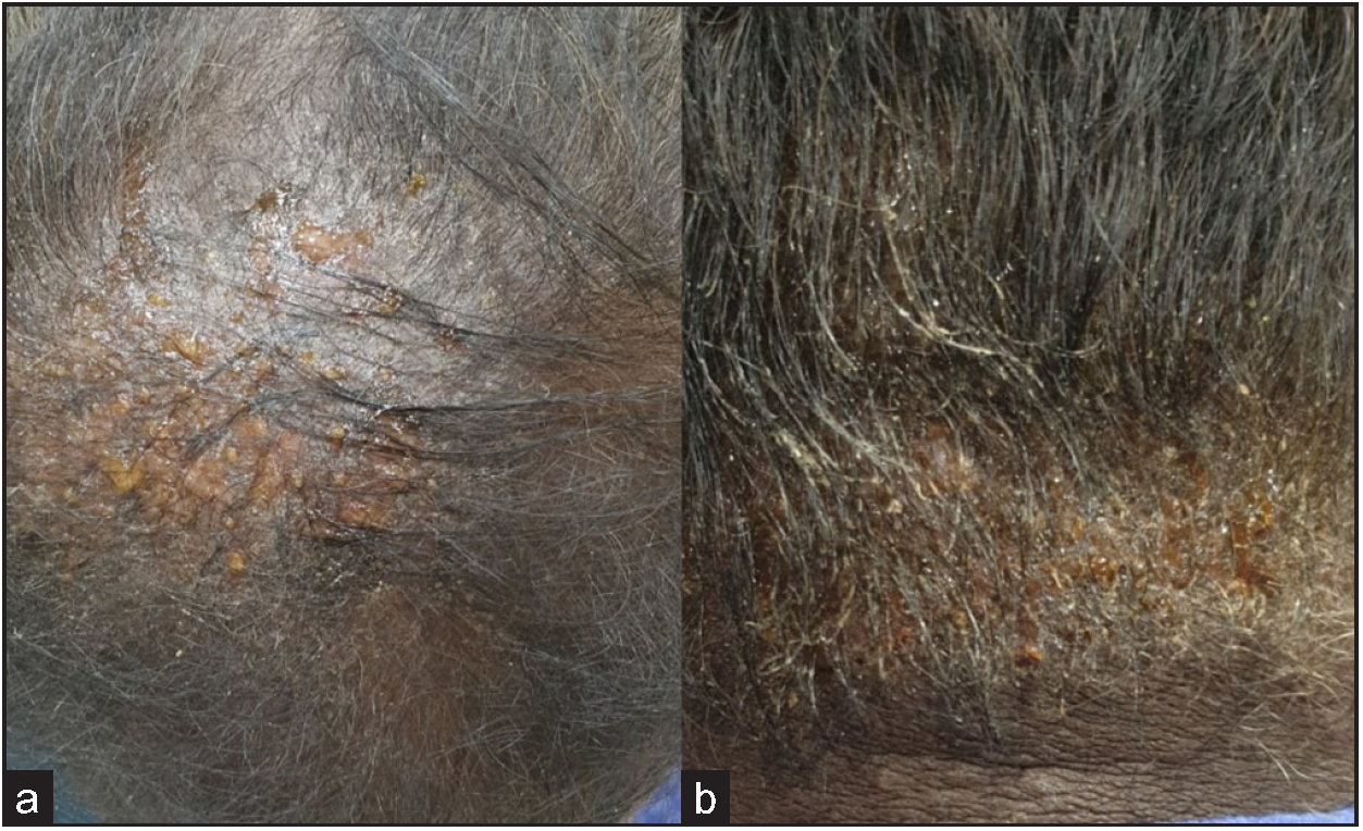 Vesiculation, oozing and crusting associated with hair dye use.
