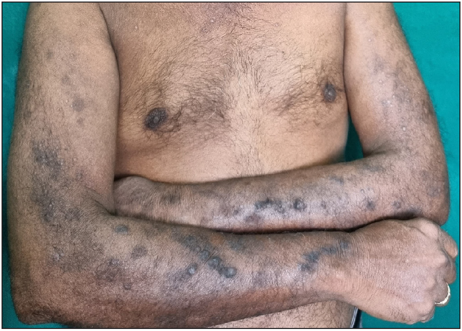 A hair dye user with pigmentary changes over the face and prurigo-like lesions over the upper extremities with positive patch test for para-phenylene diamine. Differential diagnoses of Riehl’s melanosis and ashy dermatoses for the face were considered. Prurigo nodularis and hypertrophic lichen planus were considered for the upper limb lesions.