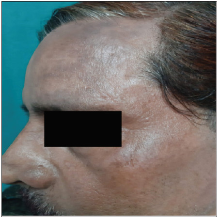 Hyperpigmented macules present over the scalp hairline and forehead region in patients with allergic contact dermatitis to hair dye.