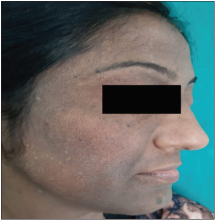 Diffuse hyperpigmentation over the face predominantly involving the forehead, cheeks and chin in patients with contact dermatitis to facial cosmetics.