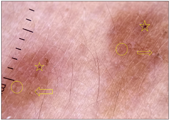 Dermatoscopy of histoid leprosy where follicular plugs (yellow stars), white rosettes (yellow arrow) and branching vessels (yellow circle) with distorted pigment network are well appreciated.