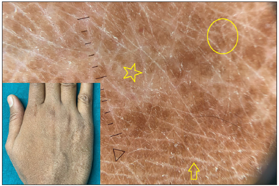 Dermatoscopy of borderline tuberculoid leprosy shows focal white areas (star), widened skin lines (arrow) and distorted pigment network (circle) over a brownish background. [Inset: respective clinical image]