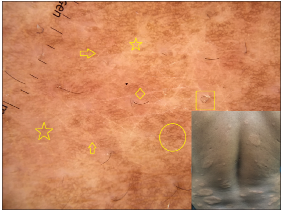 Dermatoscopy of borderline lepromatous leprosy shows focal white areas (stars), widened skin lines (arrow) and distorted pigment network (circle). Broken (diamond) and circle (box) hairs are well appreciated. [Inset: respective clinical image]