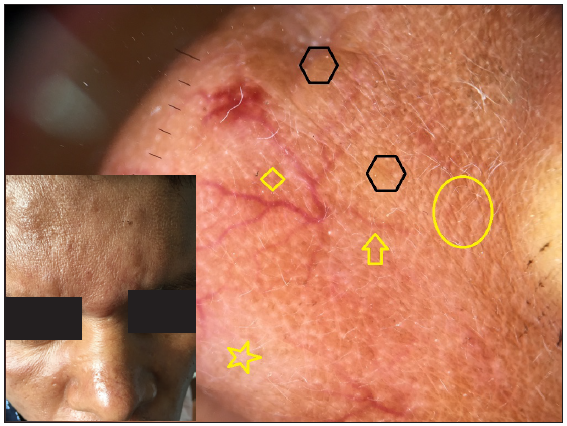 Dermatoscopy of lepromatous leprosy shows focal white areas (stars), yellowish-white globules (hexagons) and linear (arrow) and branching (diamond) vessels. Distorted pigment network (circle) is well appreciated. [Inset: respective clinical image]