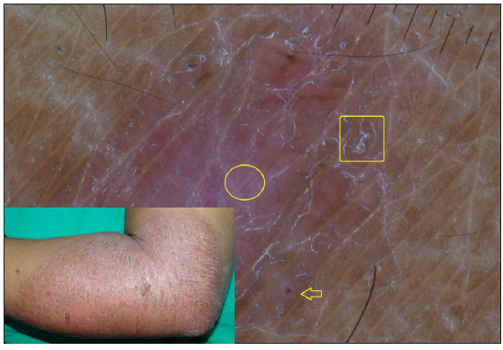 Dermatoscopy of type 1 reaction shows short liner blurry vessels (circle), follicular plugs (arrows) and scales (box) over a pinkish background. [Inset: respective clinical image]