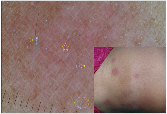 Dermatoscopy of type 2 reaction shows perifollicular scales (arrows) and circle hairs (circle) over a pinkish background (star). [Inset: respective clinical image]