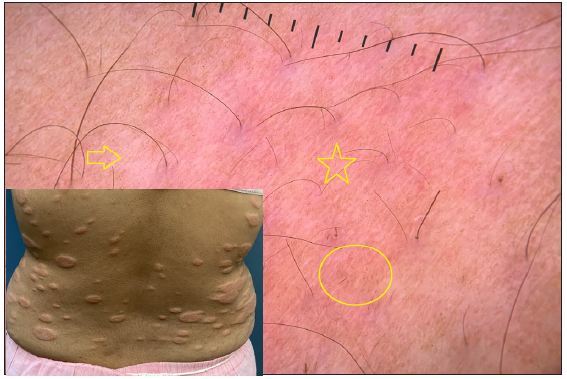Dermatoscopy of borderline lepromatous leprosy shows white shiny streaks (arrow), distorted pigment network (circle) and pinkish hue (star). [Inset: respective clinical image]