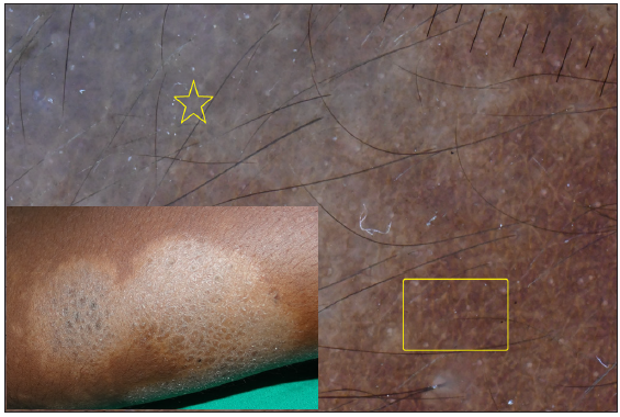 Dermatoscopy of borderline tuberculoid leprosy showing bluish pigmentation (yellow star) and distorted pigment network (yellow box).