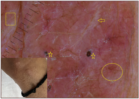 Dermatoscopy of histoid leprosy showing follicular plugging (stars), white shiny streaks (arrow) and pinkish background. Note the linear (box) and branching vessels (circle). [Inset: respective clinical image]