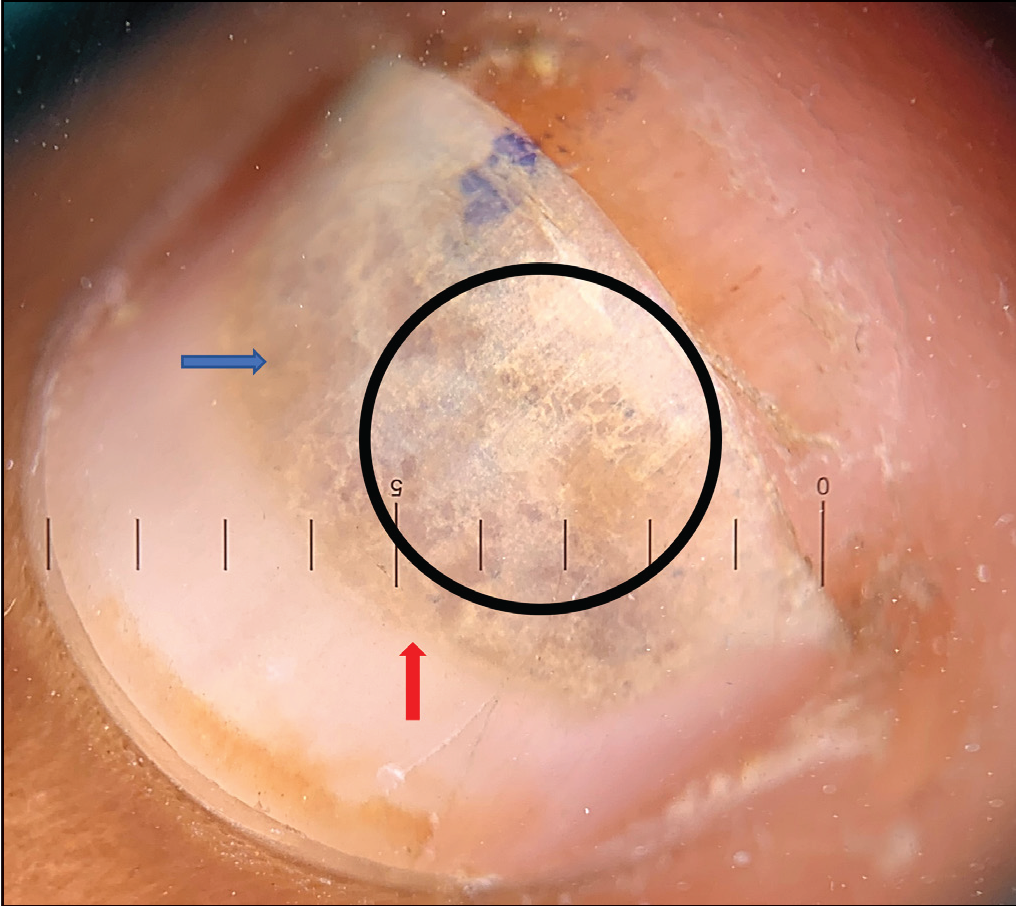 White honeycombing (black circle) with background yellow brown areas (blue arrow) and sharp proximal yellow border (red arrow).