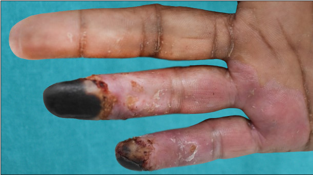 Palmar aspect of the hand showing dry gangrene on tips of the fourth and fifth digits with a clear line of demarcation.