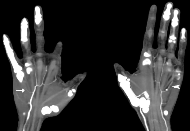 Coronal CT angio arterial phase image of bilateral hands showing severe luminal narrowing of the common palmar digital artery supplying the fourth and fifth digits of the right hand (arrow head) as compared to the normal common palmar digital artery supplying the fourth and fifth digits of the left hand (arrow head).