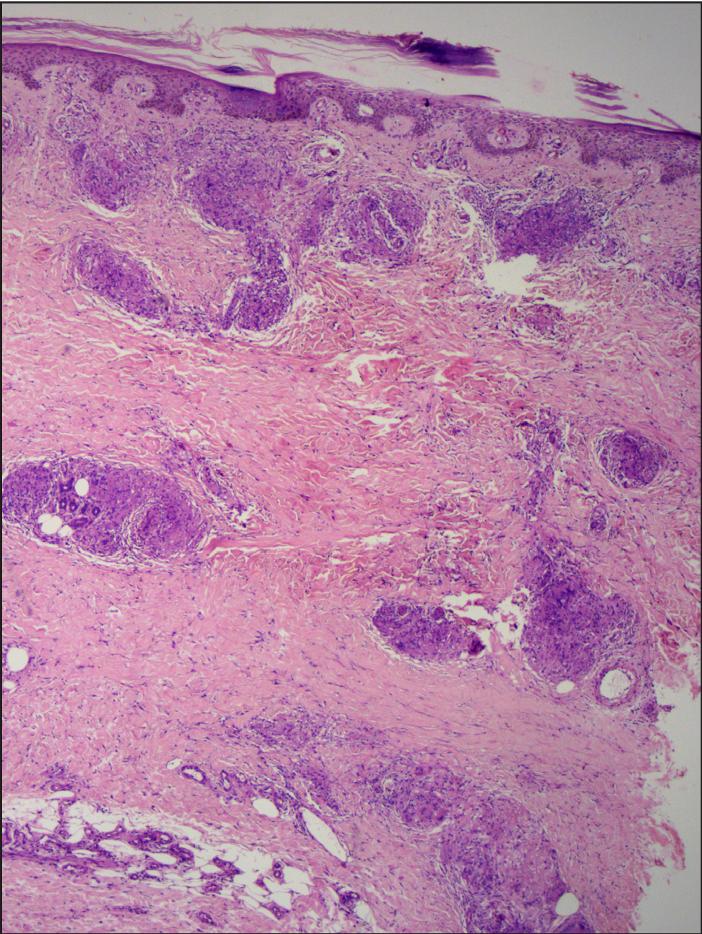 Histopathology shows multiple non-caseating naked epithelioid granulomas in the dermis and subcutaneous tissue (Haematoxylin & Eosin, 50x)
