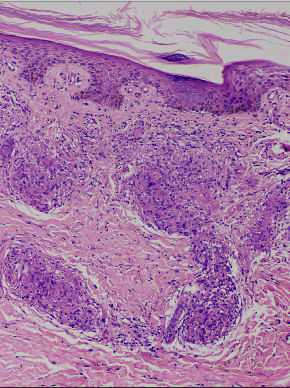 Naked sarcoid granulomas without any lymphocyte cuffing (Haematoxylin & Eosin, 100x)