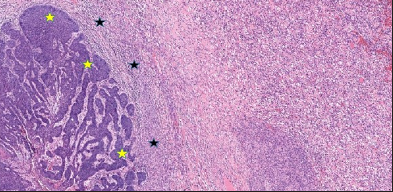 BCC island within palisading artifact (yellow asterisk) in close contact with a spindle cell tumor in the dermis (black asterisk) (Haematoxylin & Eosin, 40x)
