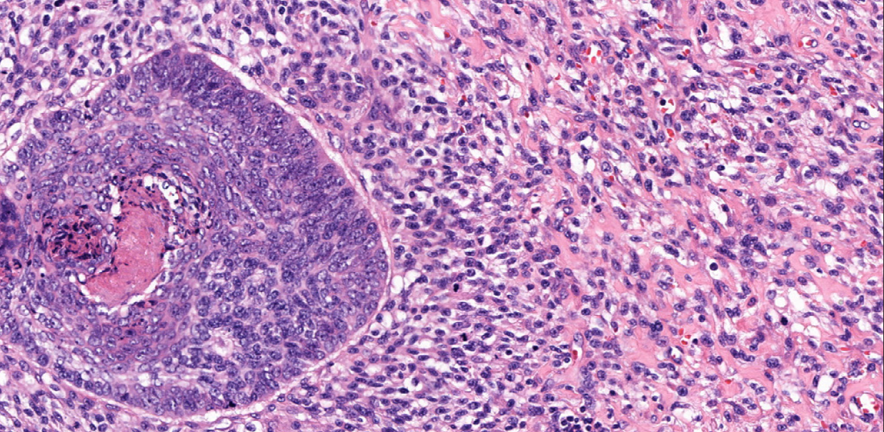 Details of a combined tumor of a BCC and an AFX (Haematoxylin & Eosin, 200x)