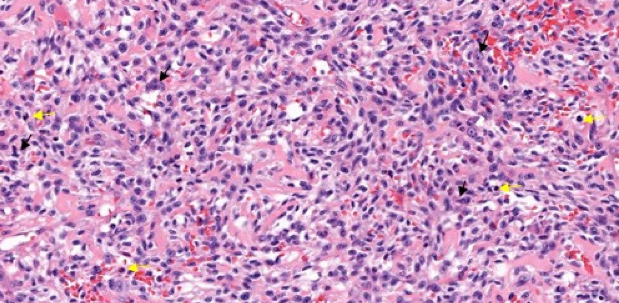 Dermal proliferation composed of atypical spindle cells with pleomorphic nucleus (black arrows) and frequent atypical mitosis (yellow arrows) (Haematoxylin & Eosin, 200x)
