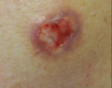 Ulcerated pink plaque (2.0 × 1.0 cm) with violaceous border on the right posterior shoulder.