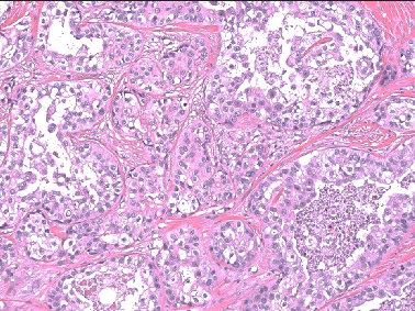 Proliferation of infiltrating glandular structures within the dermis with ductal structures showing markedly pleomorphic squamoid cells (Haematoxylin & Eosin, 200x).