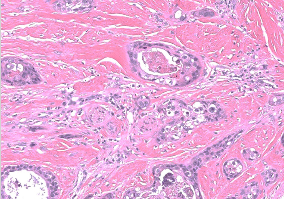 Tumour cells with foci of intraluminal necrosis and perineural infiltration (Haematoxylin & Eosin, 200x)