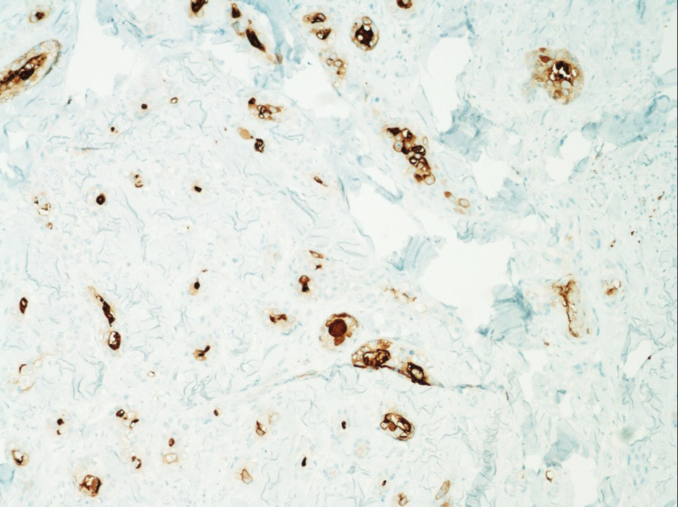 CEA immunostaining showing intraluminal staining pattern within the tumour cells (IHC, 100x).