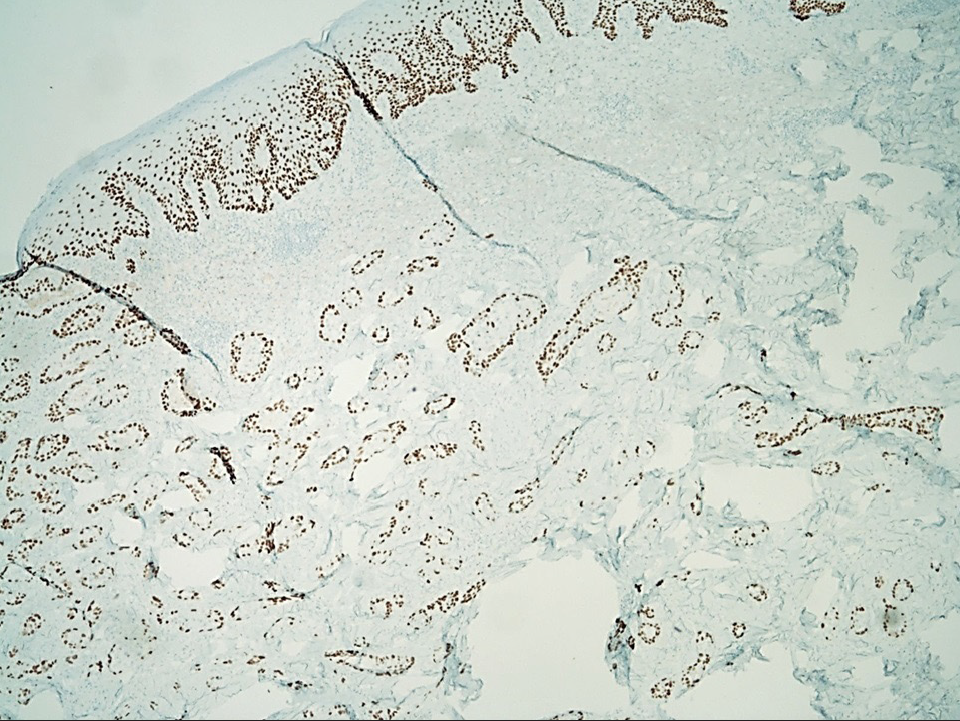 p63 immunostain is positive in the tumour cells (IHC, 40x).