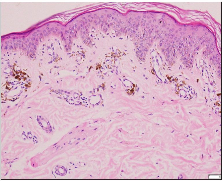 Histopathological examination showing focal interface dermatitis with pigment incontinence and melanophages (Haematoxylin & Eosin, 400×)