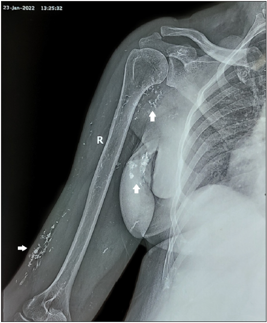 X-ray showing multiple calcifications (white arrows) over the right arm.