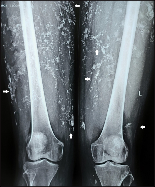 X-ray showing multiple calcifications (white arrows) over both thighs.