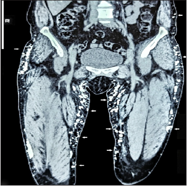 CT scan: Coronal section showing coarse subcutaneous calcifications in flanks and thighs (white arrows).