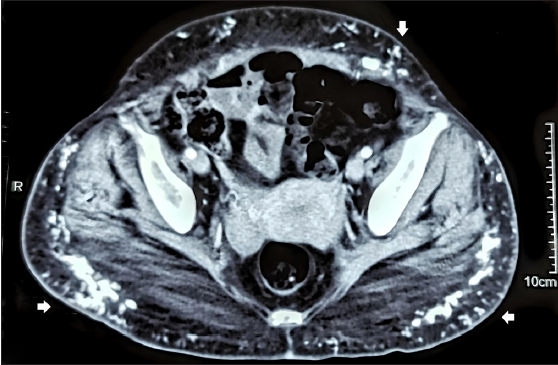 CT scan: Axial section showing calcification (white arrows) in subcutis of upper thighs.