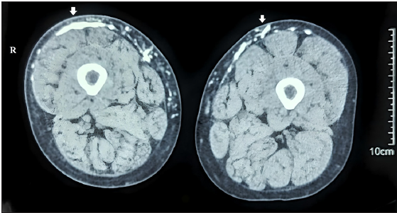 CT Scan: Axial section showing calcification (white arrows) in subcutis of lower thighs.