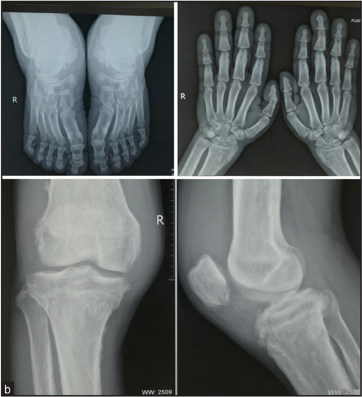 The feet radiograph shows cortical thickening and acro-osteolysis (top left panel). Hand radiograph shows a loss of the normal tabulation of metacarpals and phalanges and cortical thickening of the metacarpals and the proximal and middle phalanges (top right panel). X-ray of the knee display periosteal hyperostosis, patellae sclerosis, and sclerosis of both the distal femur and tibiofibular (lower panel).