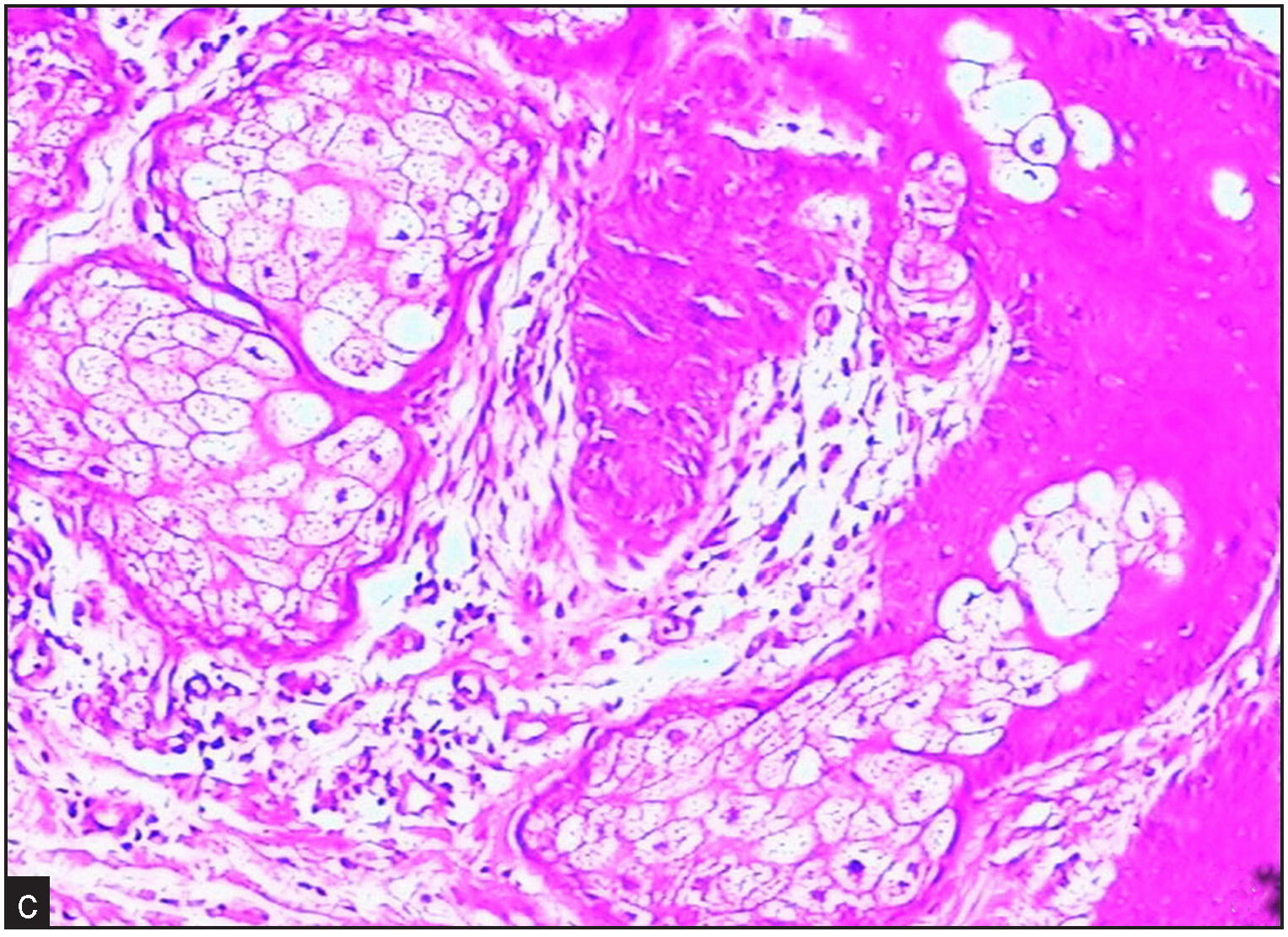 Forehead skin pathology shows significant sebaceous gland proliferation (Haematoxylin & Eosin, 100x).