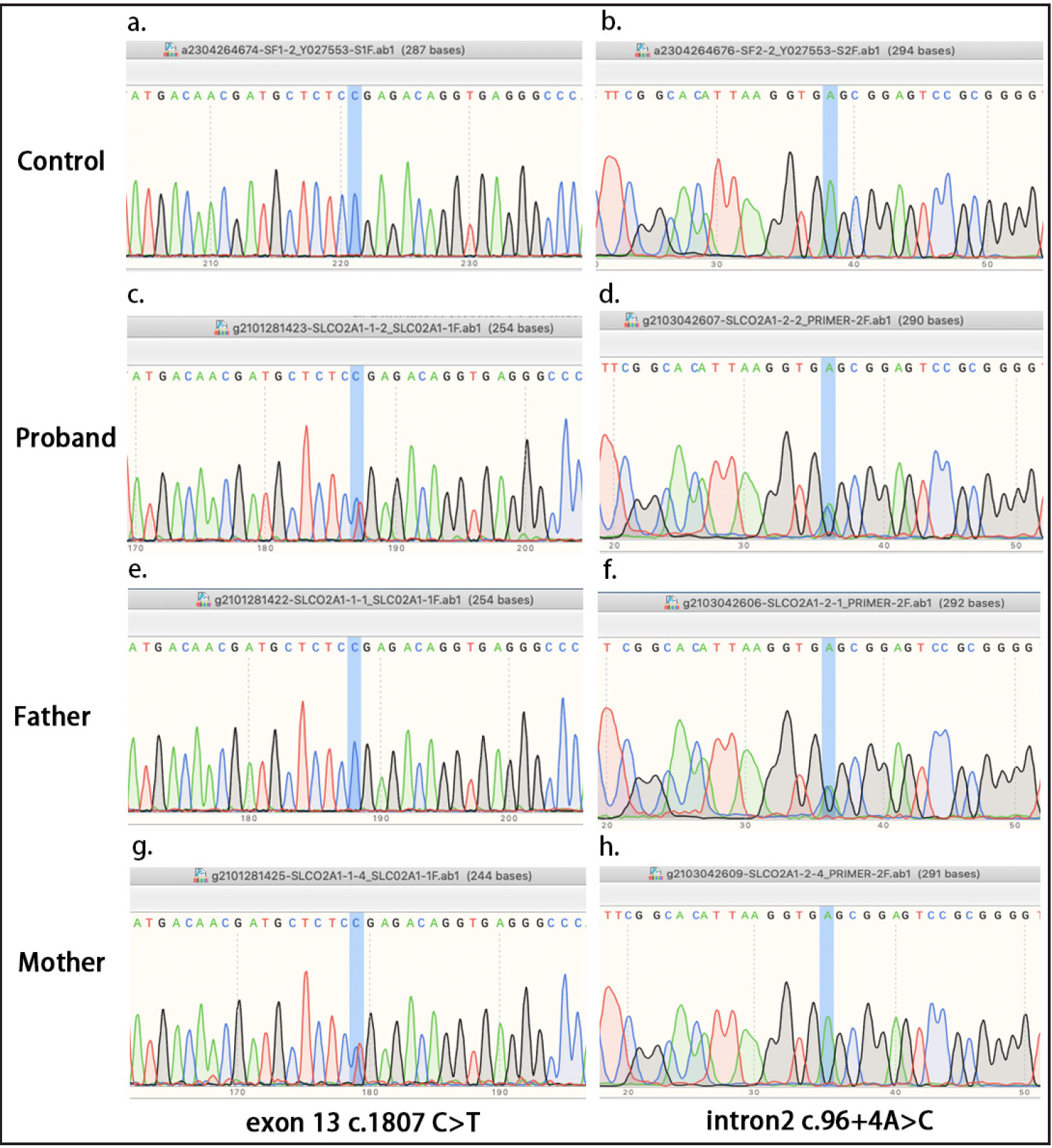 Mutation analysis of the SLCO2A1 gene. (a–b) No mutations were detected in SLCO2A1 in healthy controls. (c–d) The proband carries the c.96+4A>C in the exon-intron 2 boundary and the c.1807 C>T mutations in exon 13. (e–f) Heterozygous c.96+4A>C intronic splicing mutation in the patient’s father. (g–h) Heterozygous c.1807 C>T exonic mutation in patient’s mother.