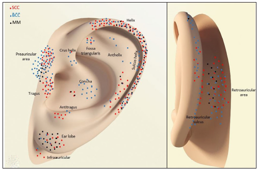 Anatomical distribution of BCC, SCC and MM according to auricular subunit.