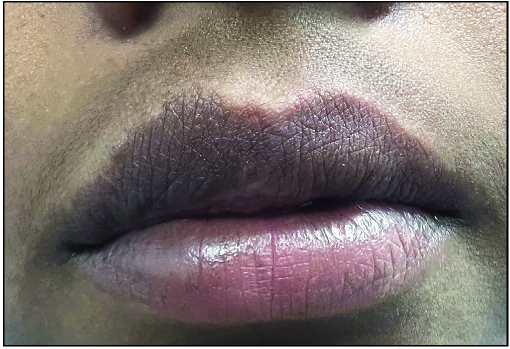 Reduction in the labial swelling after six sessions of intralesional radiofrequency ablation.