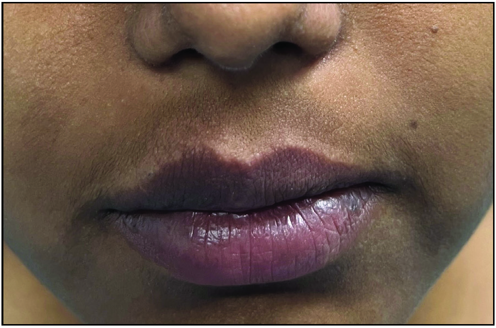 Improved lip contour after six sessions of intralesional radiofrequency ablation and lip reduction surgery.