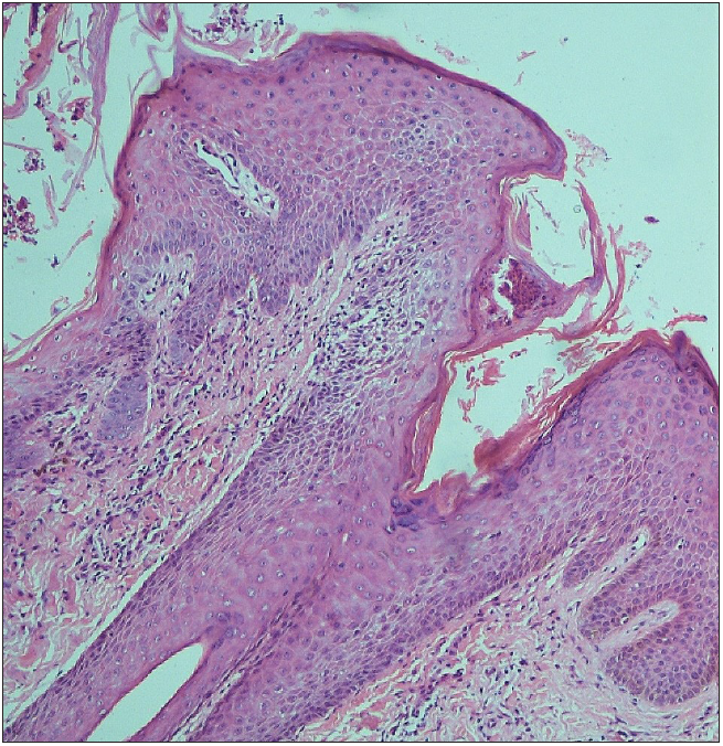 Epidermal bullae and keratinocyte necrosis (Haematoxylin and eosin; 100x).