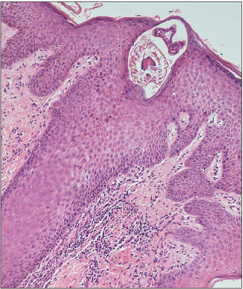 Mite identified in a subcorneal burrow on serial sections. Note perivascular and perifollicular chronic inflammatory infiltrate in the dermis (Haematoxylin and eosin; 100x).