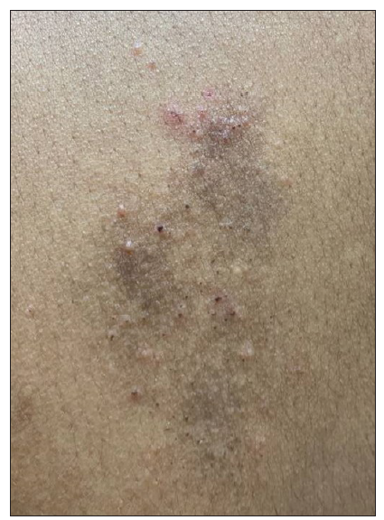 Multiple grouped vesicles and crusted papules on a background of normal skin and a few lesions healing with hyperpigmentation – upper back.