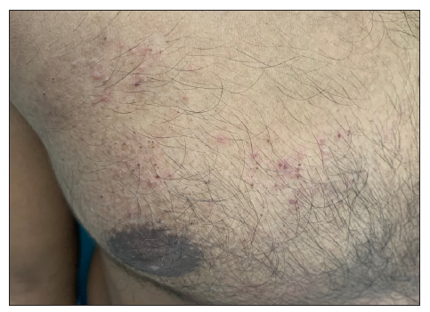 Multiple grouped vesicles and crusted papules on a background of normal skin and a few lesions healing with hyperpigmentation – chest.