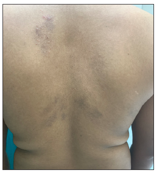 Multiple grouped vesicles and crusted papules on a background of normal skin and a few lesions healing with hyperpigmentation – back.