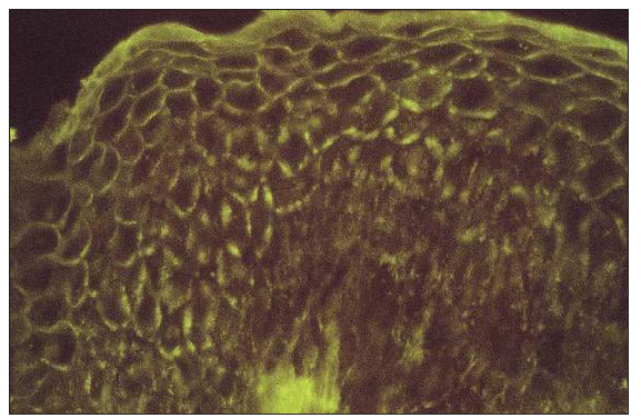High power image of direct immunofluorescence from perilesional skin showing intercellular deposition of IgG (Intensity 2+) – fishnet pattern positivity predominantly in the upper layer of the epidermis (DIF - IgG) (200x).