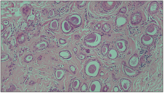 Histopathology showing multiple variable-sized eccrine tubules with secretions and lined with a double layer of epithelium along with a few immature pilar structures (Haematoxylin & Eosin; 100x).