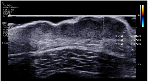 Under ultrasound, the tumour presents with low echogenicity, primarily located within the dermis. It exhibits unclear boundaries, irregular surface protrusions, and a blurred base. Colour doppler flow imaging reveals abundant blood flow signals.
