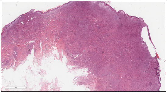 Epithelioid and fusiform cells diffusely infiltrate from dermis to subcutaneous adipose layer, with interstitial mucoid degeneration. (Haematoxylin and Eosin, 40x).