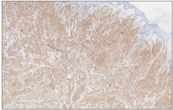 Immunohistochemical staining of Smooth muscles actin (SMA) of tumour cells (100x).