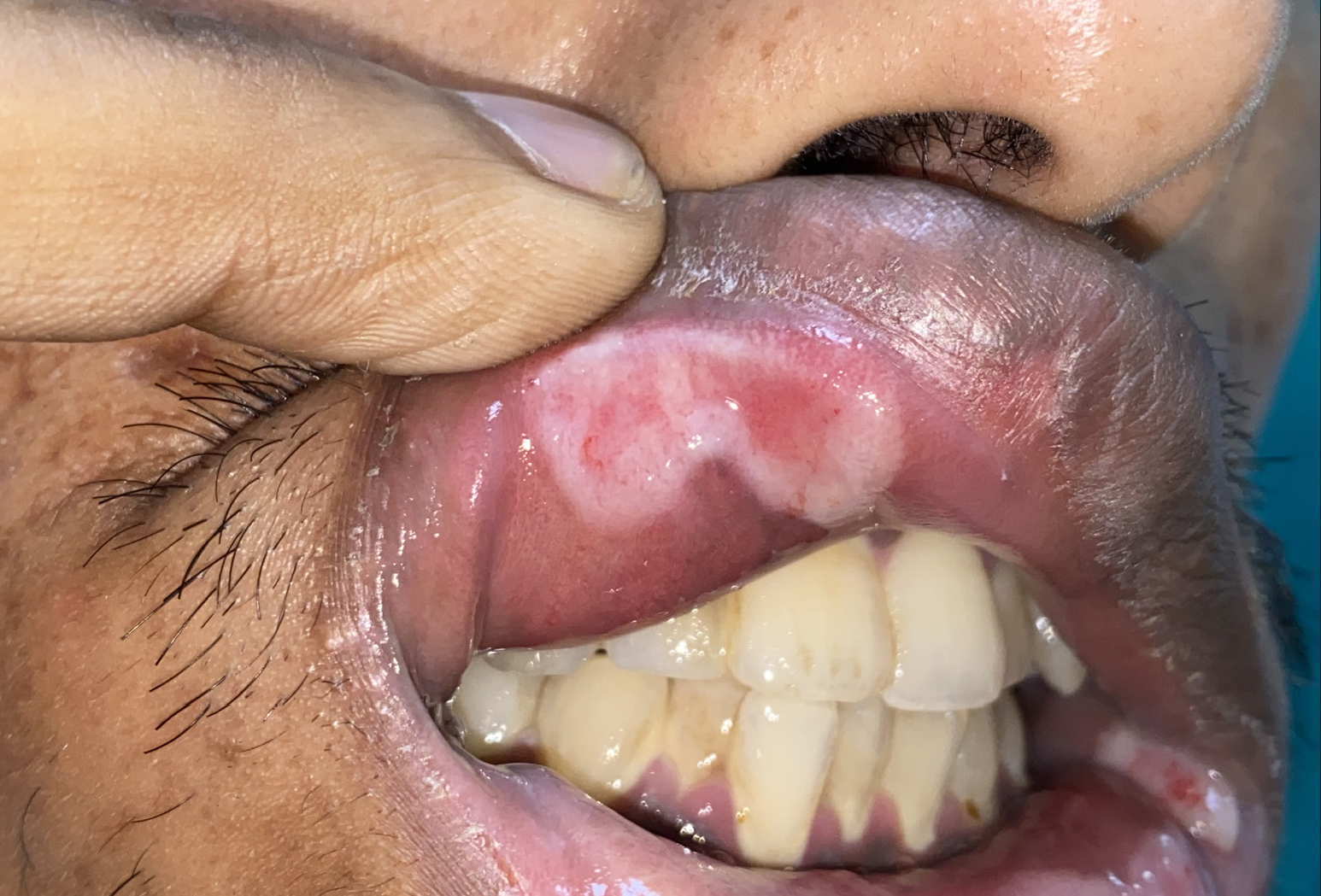 Erythematous to whitish tumid plaque seen on the upper labial mucosa and split papule seen on the left angle of mouth.