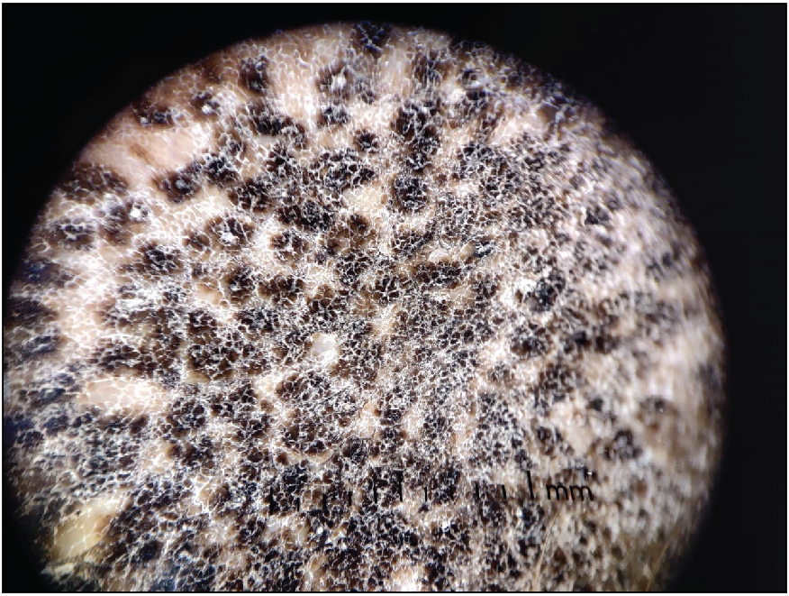 Reticulo-globular pattern with intervening normal skin seen on dermoscopy.